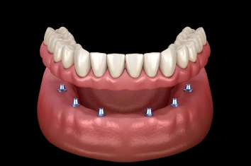 Implant Supported Bridge