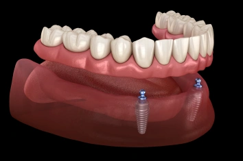 Implant Supported Bridge