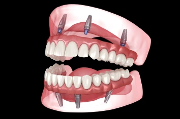 Implant Supported Bridge