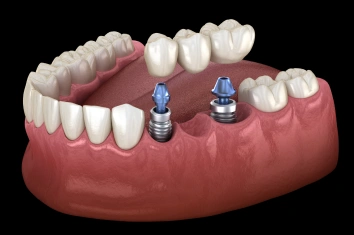 Implant Supported Bridge