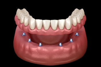 Implant Supported Dentures