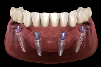 Implant Supported Bridge