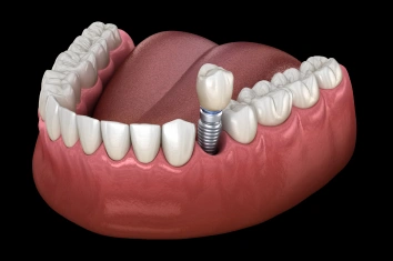 Single Dental Implants