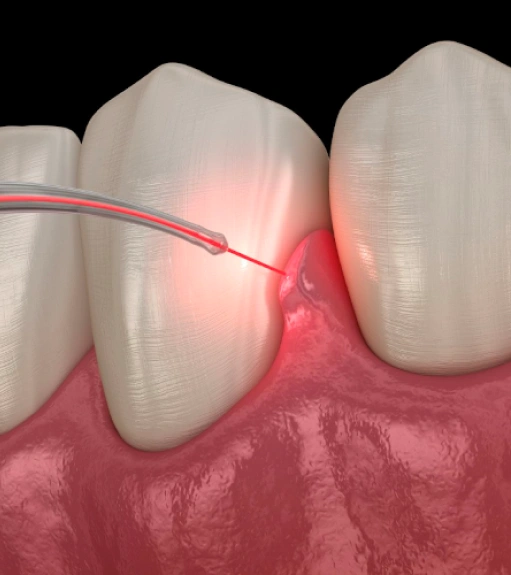 Comfortable Care With Laser Dentistry