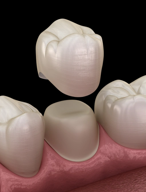 Porcelain Crowns