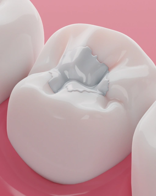 Tooth Colored Fillings